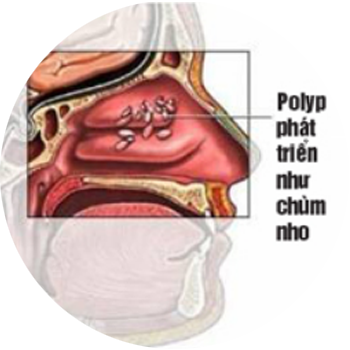 Polyp mũi